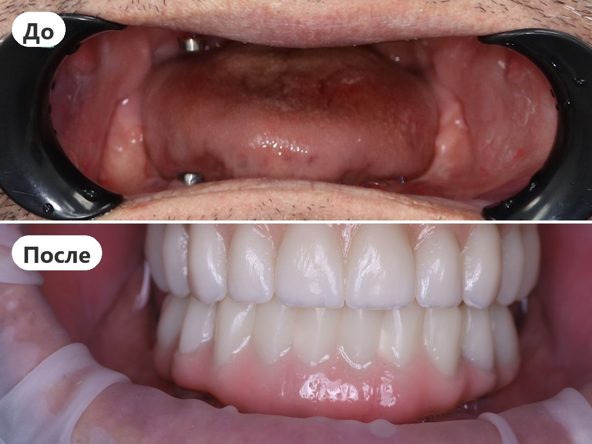 До и после лечения, пациент клиники Denta