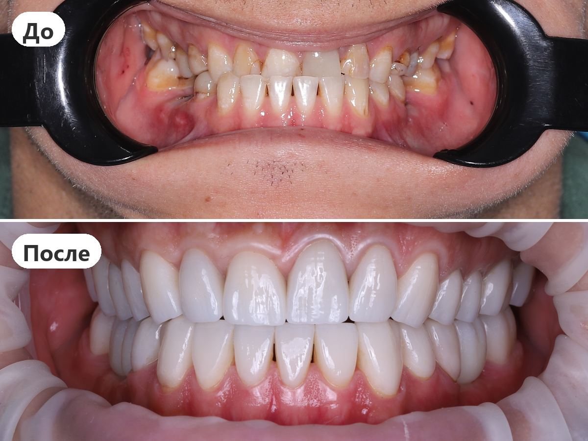 До и после лечения, пациент клиники Denta