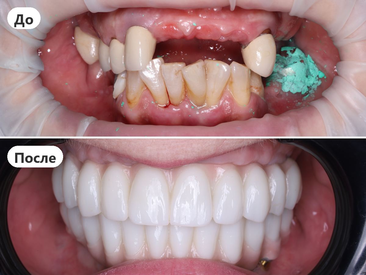 До и после лечения, пациент клиники Denta