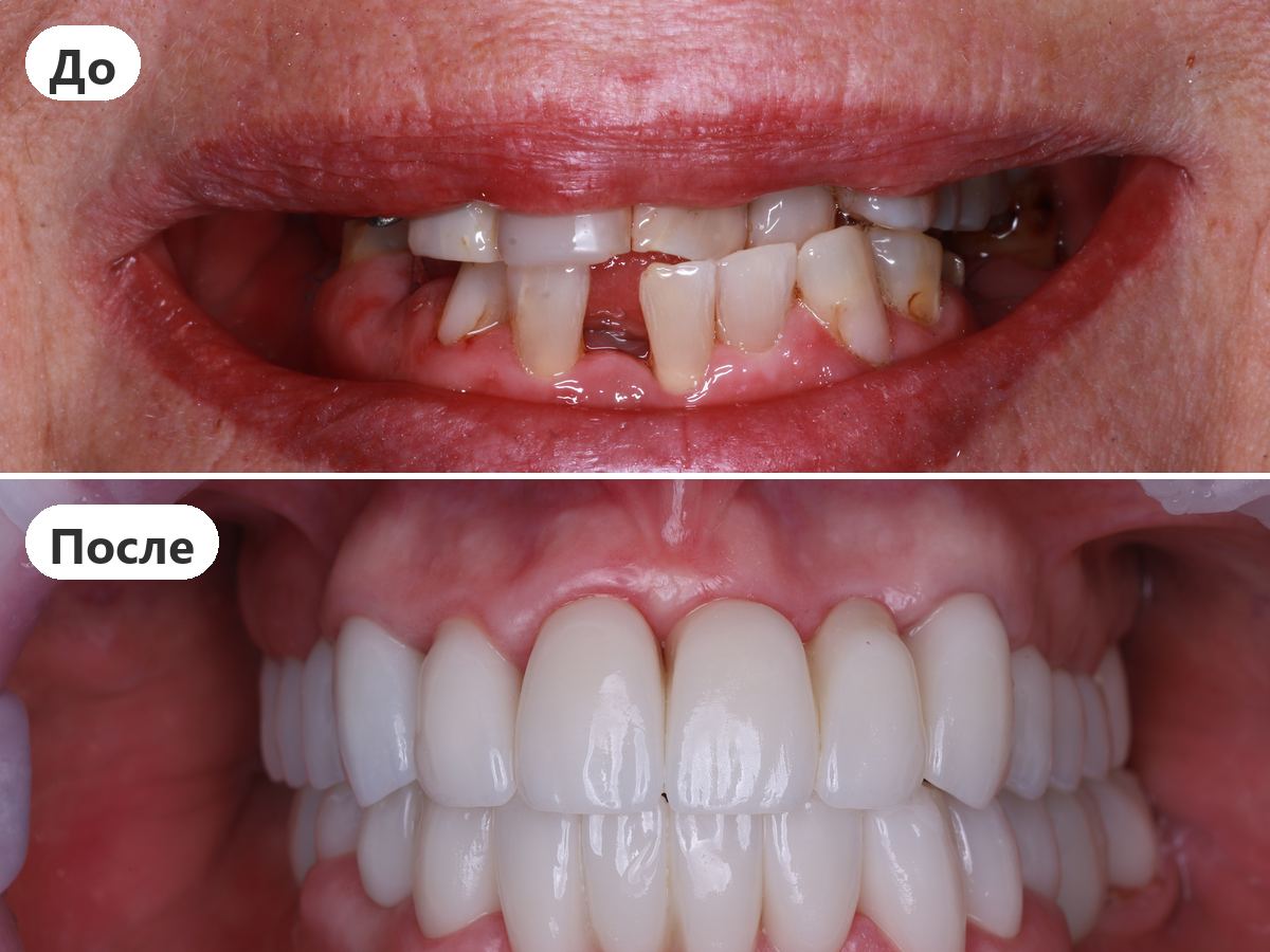 До и после лечения, пациент клиники Denta