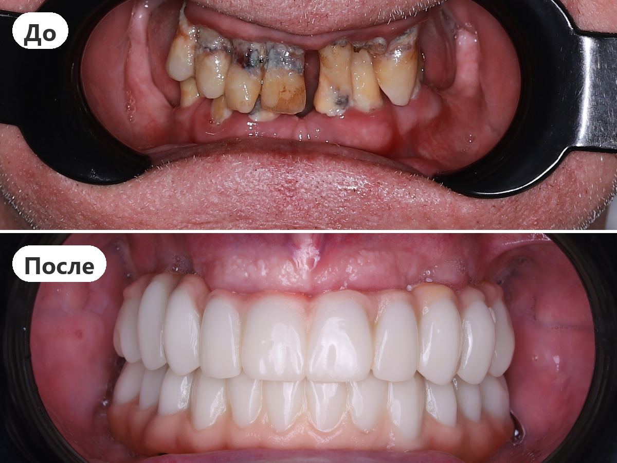 До и после лечения, пациент клиники Denta